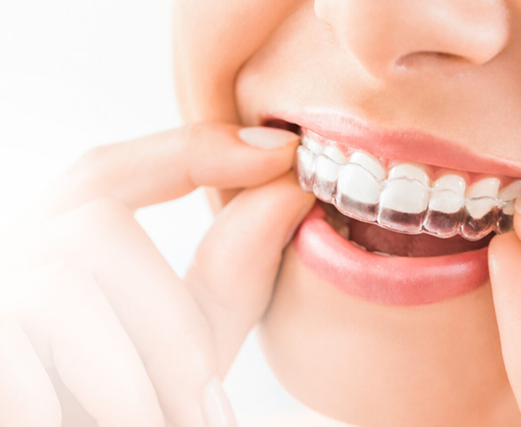 invisalign aligners swansea