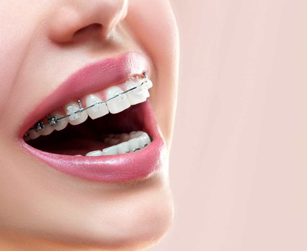 invisalign swansea, south wales