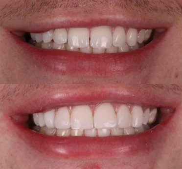 cosmetic dentistry in mumbles