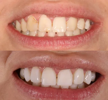 cosmetic dentistry treatment