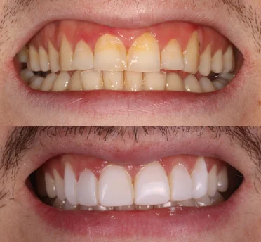 composite bonding before after composite bonding before after