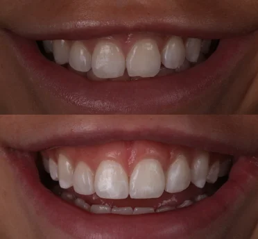 composite bonding in mumbles swansea composite bonding in mumbles swansea