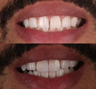 composite bonding patient omposite bonding patient