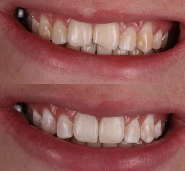 composite bonding results composite bonding results